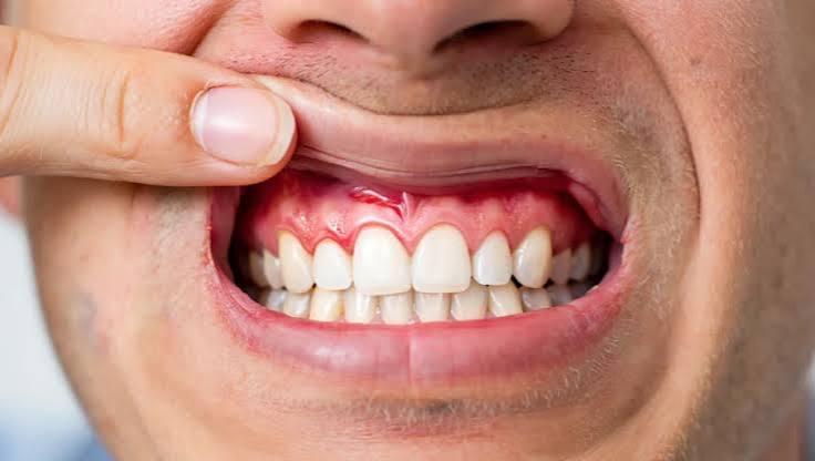 Paradontologie-craiova-dr-dent