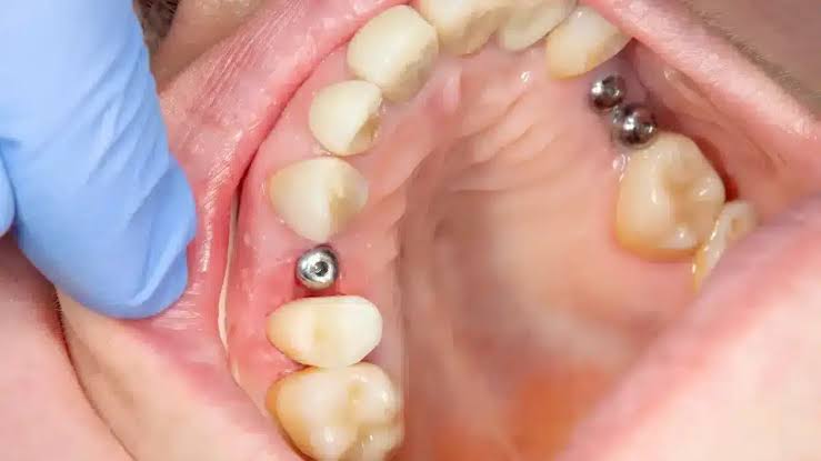 cand-se-recomanda-implantul-dentar