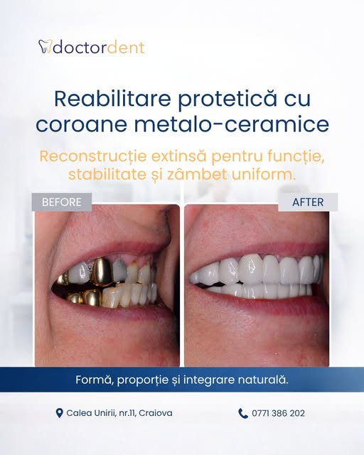 caz-dentar-coroane-metalo-ceramice