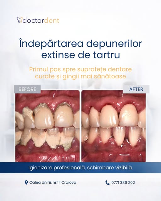 caz-dentar-depuneri-tartru
