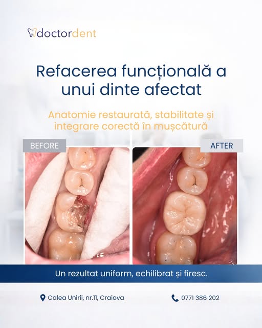 caz-dentar-dinte-refacut