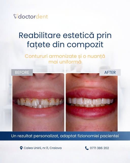 caz-dentar-fatete-compozit