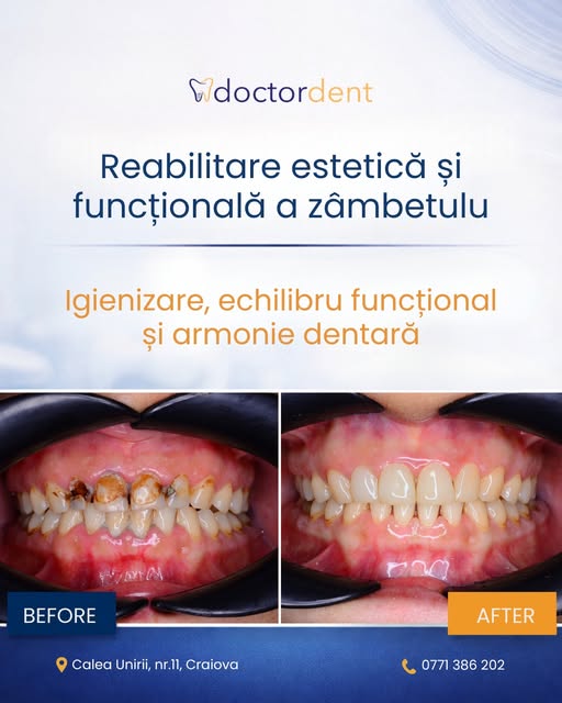 caz-dentar-implant-dentar2