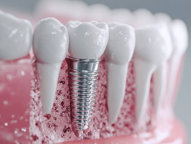 ce-este-un-implant-dentar