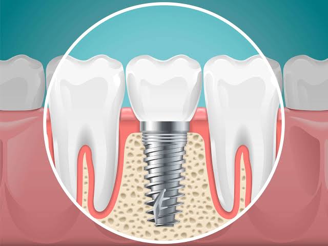 implant-dentar-craiova