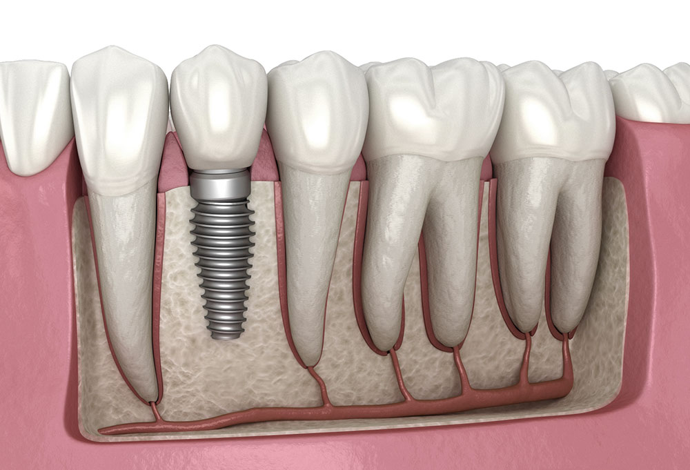 implant-proteza-sau-punte-dentara