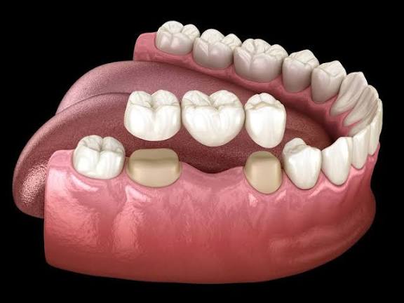 punte-dentara-drdent